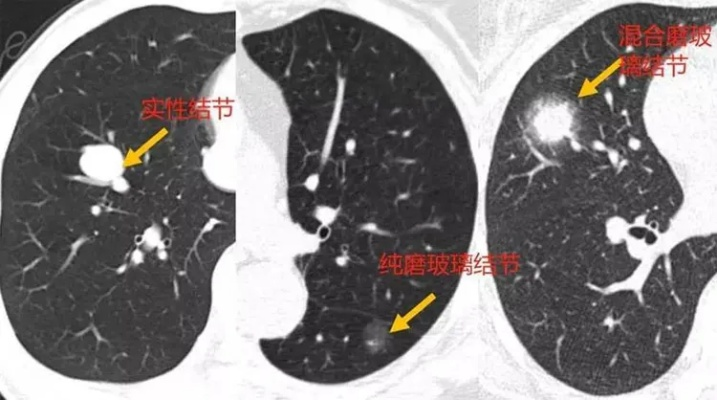 肺部小结节的成因及治疗方法介绍